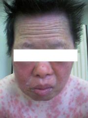 Red Facial Swelling! 

Skin eruption seen in 87% of patients! (can be morbilliform exanthem, exfoliative -red and scaly- follicular, SJS/TEN)