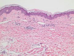 What are histologic features of urticarial allergic drug eruption?

What is a "Complex" Urticarial drug eruption