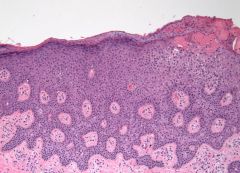 Describe the histologic changes in Photoallergic reaction.

What drugs are classically involved?