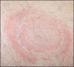 What is EAC-like cutaneous drug reaction? What drugs are commonly involved?