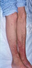 What type of allergic reaction is leukocytoclastic vasculitis?

How does it appear?