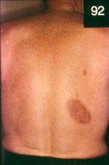 A CDR that recurs at same site (typically 1-2 wks after initial exposure, and hours after recurrent exp)

-Dusky, red round macule. Can become bullous. When it heals it becomes hyperpigmented.