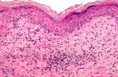 What features do you see on histology of a fixed drug eruption?