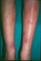 What is this cutaneous drug reaction called (note: it may also be associated with infections).