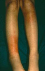 Erythema Nodosum (tender, subcutaneous nodules on shins. from inflammation in the fat). 

- Rx: rest (tends to spontaneously resolve), NSAIDS, potassium iodide