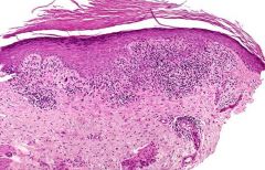 What is seen on the histology of Lichenoid Drug Eruption? How does it differ from Lichen planus?