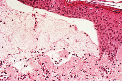 Bullous pemphigoid

Affects the hemidesmosomes, so dermis is intact while the epidermis separates and interspace fills with fluid. Intraepithelial junctions intact.