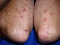 What is Dermatitis Herpetiformis characterized by?