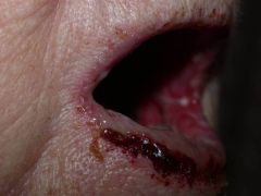 A person comes in presenting with these oral hemorrhagic ulverating lesions that are refractory to treatment. Previously they were incorrectly diagnosed with Stevens-Johnson syndrome. They have not had any other problems to date.

What should you warn t