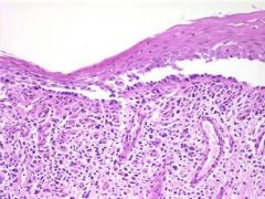 What is characteristic about the pathology of Paraneoplastic Pemphigus (PNP)?

What antibodies are formed?