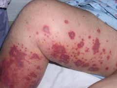What is another name for Cutaneous Small Vessel Vasculitis (CSVV)?

What type of hypersensitivity reaction is it? Describe the pathogenesis