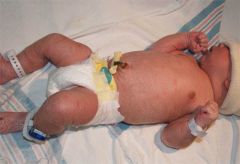 What is vernix caseosa? 

When is epidermal maturation complete in the newborn?