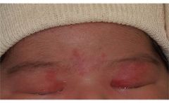 Angel's kiss or "Nevus simplex" capillary stain

Around 50% persist throughout life. Can fade and return when baby becomes emotional/cries. Not bruises (eyelid bruising is rare in babies!)