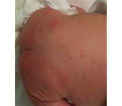 What is this common rash? When does it develop?