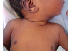 Transient neonatal pustular melanosis

Develops in african american children IN UTERO. Sometimes see colarette of scale (from desquamation around lesion).