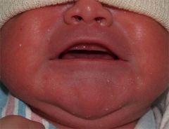 What is the small lesion on the baby's right cheek?