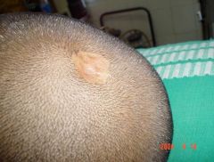 What is this lesion called? If it occurs at the vertex/midline what can it be associated with?
