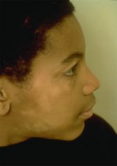 What might this person be affected with? How can you tell the difference between this and Vitiligo?