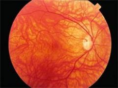 This is the fundus exam of a person with what condition? How can you tell? What would the person look like if you transiluminated their eye?