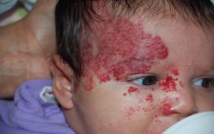 What is this? What might this child have in addition to this lesion?