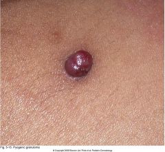 This lesion is often confused with a hemangioma. What is it?