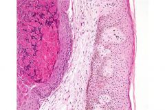 What is the causative agent seen in this pathology? What type of infectious agent is it and how is it transmitted?