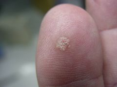 What type of wart is this? what is the black dot?