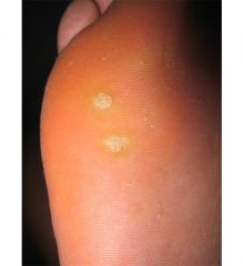 How do you distinguish these spots (are they warts or corns)?