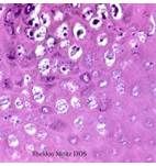 What is seen on this histopathology? How do you treat it?