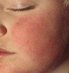 What infectious agent causes this disease? How was it transmitted? Is the child contagious?
