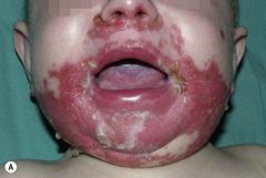 What is this condition called? How would the baby present? How would you treat it?