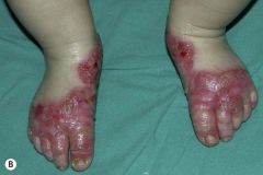 Acrodermatitis enteropathica 
Baby may be irritable, have diarrhea, periorofacial/acral dermatitis, and alopecia

Typically seen after weaning (lack of Zn from breast milk). GIVE ZINC!