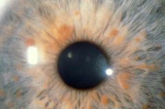 2+:
6+ cafe au lait
Axillary freckling
Plexiform neurofibroma 
Two or more lisch nodules of iris
Optic nerve glioma
family history