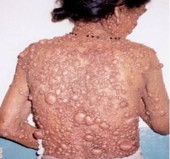 What is the mutation in individuals with Neurofibromatosis 1?

What is the mode of transmission?
