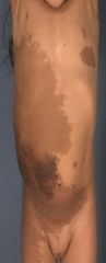 Tibial bowing (a skeletal dysplasia)- associated with NF-1. 

Also note the plexiform neurofibroma that here mimics a necus.