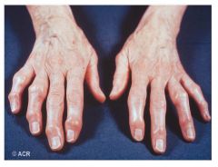 What type of arthritis does this person have? How can you tell? What are the names of the swellings?