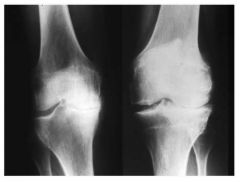 What does this knee x-ray show?