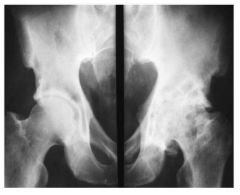 Osteoarthritis- note the reactive sclerosis (increased bone formation) and lateral joint space narrowing (loss of articular cartilage). 

*similarly seen on xray of the hip (subchondral sclerosis and osteophytes or bony spurs).