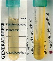 What is the composition of synovial fluid? Why is it that giving systemic medication (ex: antibiotics) in the setting of infection of the joint can easily reach the joint? 

Which of the above tubes corresponds to OA synovial tap?