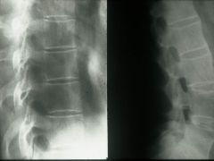 What radiologic sign is seen here that is associated with Ankylosing spondylitis? 

What other radiographic signs (seen on the vertebrae) are associated with this condition?