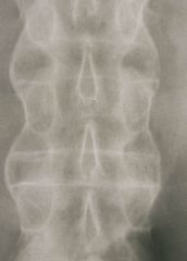 Radiologic sign- Bamboo spine (also square appearing vertebral bodies).

Others= Dagger sign (fusion of vertebral spines) and Trolley-Track sign (spinous process fuse with facet joint)