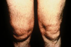 What is the pattern of psoriatic arthritis seen in this man (who has arthritis of the lower knees)?