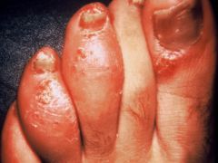 What is the pattern of psoriatic arthritis seen in this person?