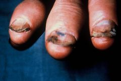 What three nail conditions are seen here?