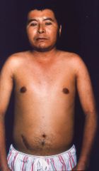 What type of systemic sclerosis does this individual have? What antibody is associated with this condition?