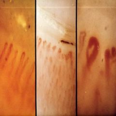 Patients can have BOTH Vasoconstriction and Vasodilatation.

Vasoconstriction: Raynaud's, Digital ulcer
Vasodilation: Telangiectasia, Nailfold capillary dilation