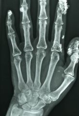 Subcutaneous calcinosis in the finger and elbows. Can be seen on xray.

very characteristic of Scleroderma.