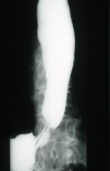 What is the problem with the barium swallow of a patient with Scleroderma?