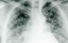 Would you expect this chest x-ray to come from a patient with lc-SSc or dc-SSc?