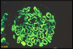 Immune complex deposition--> Mainly subendothelial deposits (and some subepithelial and intramembranous deposits).

Lumpy bumpy pattern on Immunofluorescence.